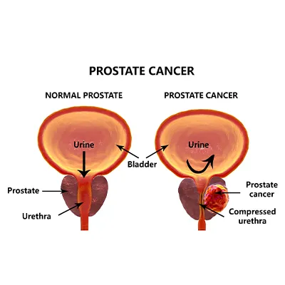 Prostate Cancer